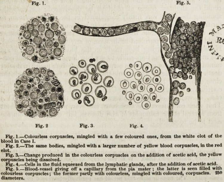 Image from Bennett of colorless corpuscules from the blood of John Menteith