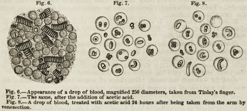 Image from Bennett of the appearance of a drop of blood taken from patient Barney Tinlay and subjected to various treatments.